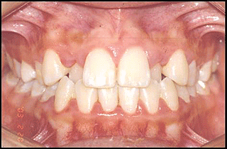 Ортодонтические работы - исправление прикуса до и после