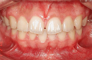 Ортодонтические работы - исправление прикуса до и после